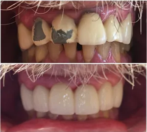 Dental Bridge Before and After procedure