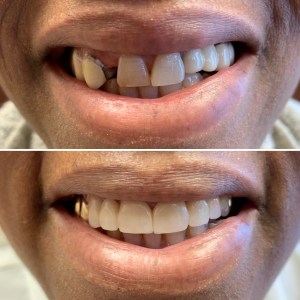 Dental Bridge Before and After