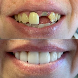 Dental Bridge Procedure Before and After