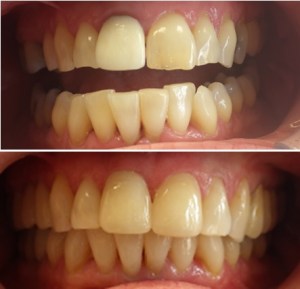 Before and After Dental Crown procedure
