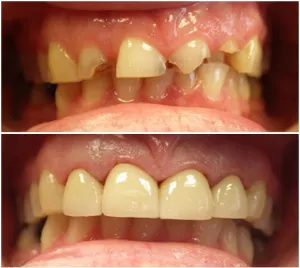 Procedure for Dental Crowns Before and After