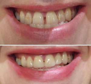 Dental Crown Procedure Before and After