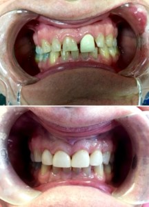 Dental Crown Before and After Procedure