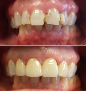 Dental Crown Before and After