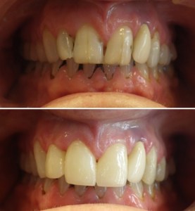 Procedure for Dental Crown Before and After