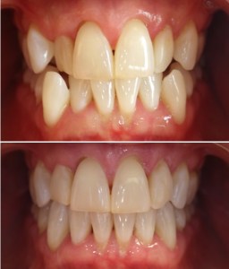 Before and after clear braces
