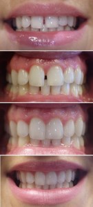 Clear Braces before and after