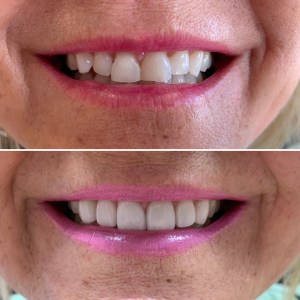 Veneers before and after