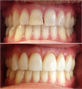 Porcelain Veneers Before and After