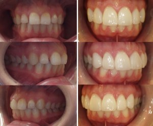 Before and after veneers