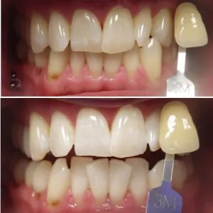Before and after teeth whitening zoom