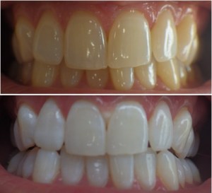 Teeth Whitening Zoom Before and after