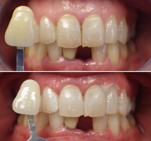 Before and after zoom teeth whitening