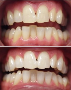 Zoom teeth whitening before and after