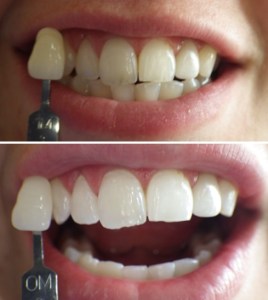 Before and after zoom whitening