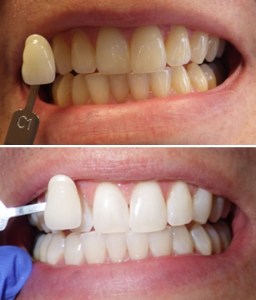 Zoom whitening before and after