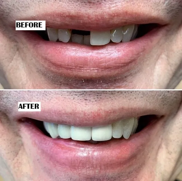 Dental bridges before and after treatment