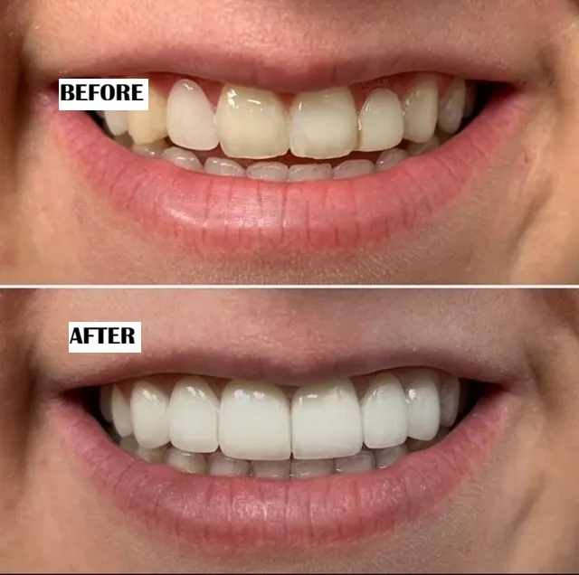 Dental bridge before and after treatment