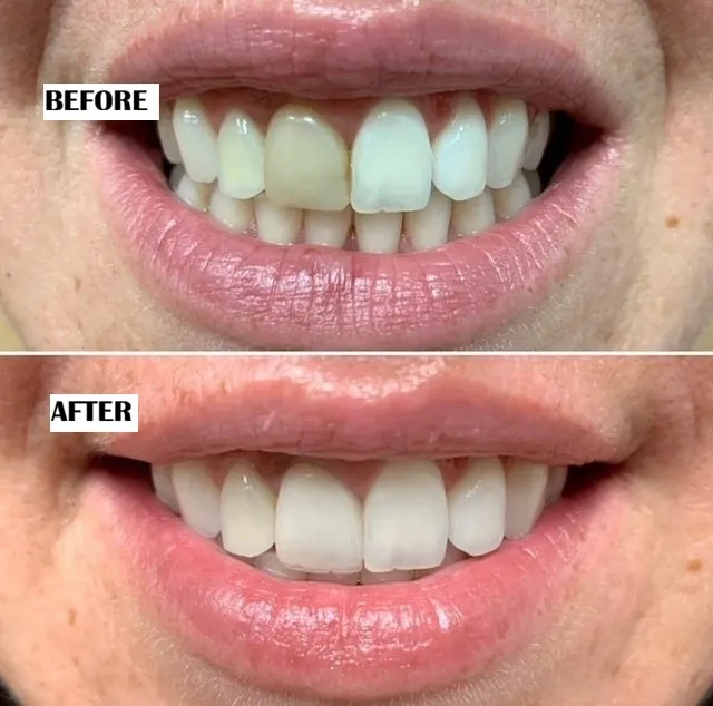 Dental crowns and bridge before and after treatment