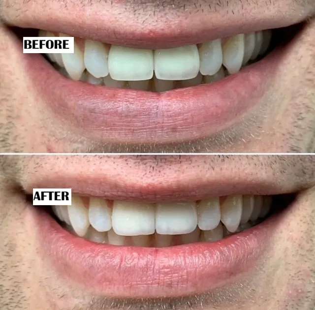 Dental crowns before and after treatment