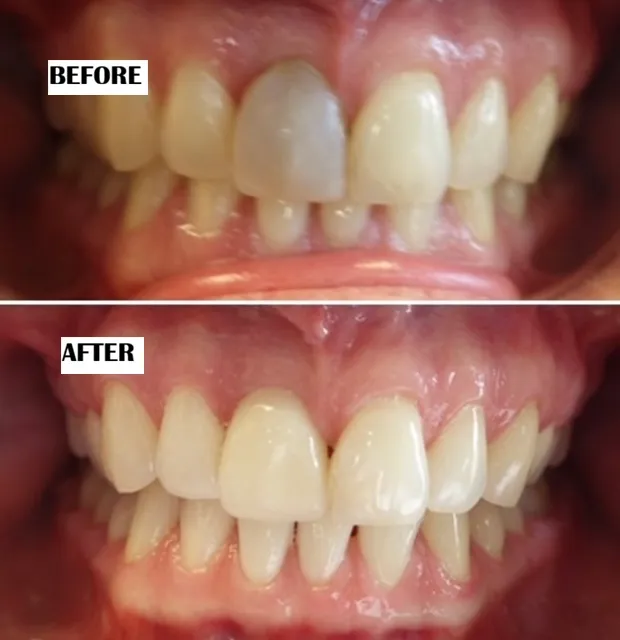 Dental implants before and after treatment